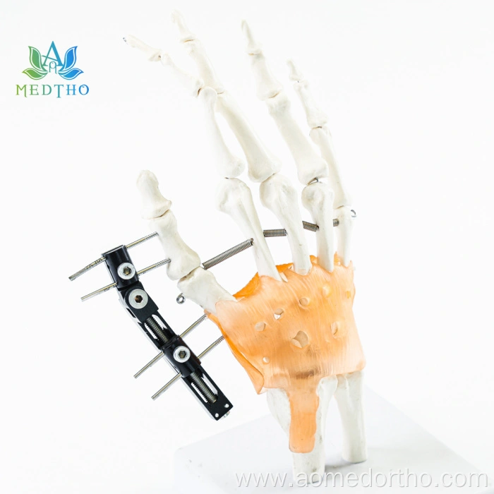 external fixator ankle